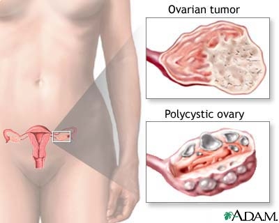 imagini sindromul ovarian